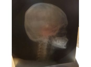 Vintage Lot Of Four Medical X Rays Of A Hamden Resident's Skull From 1950.